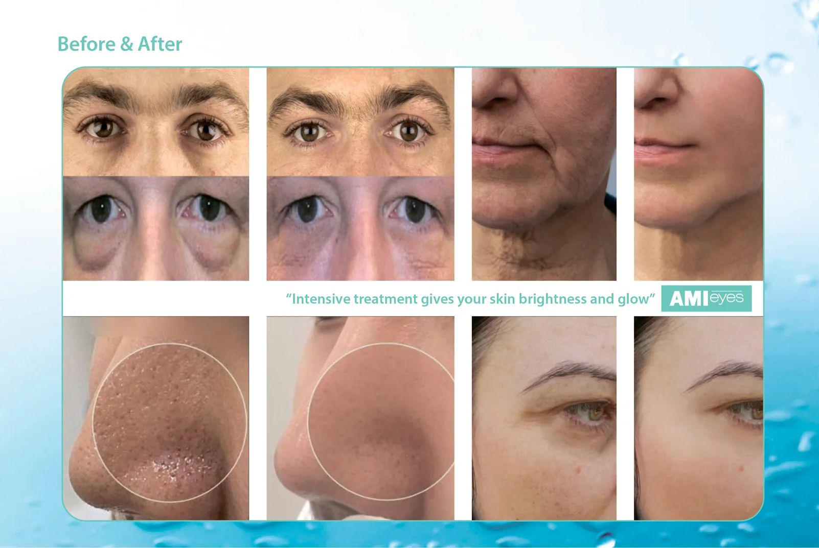 Amieyes 1 06 965A0Be8 - Botoderm