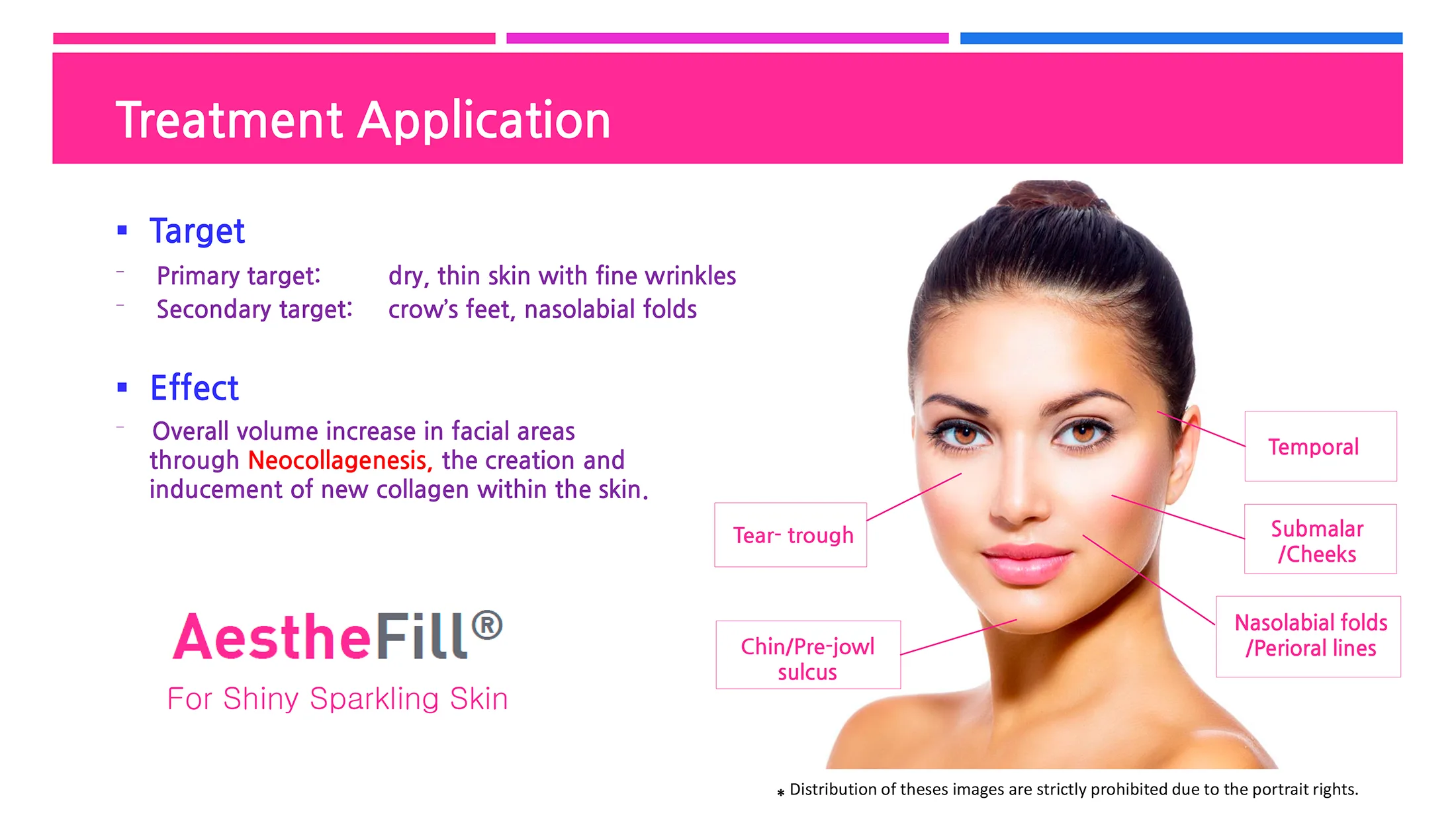 Aesthefill Plla 1 22 9F6B26A5 - Botoderm