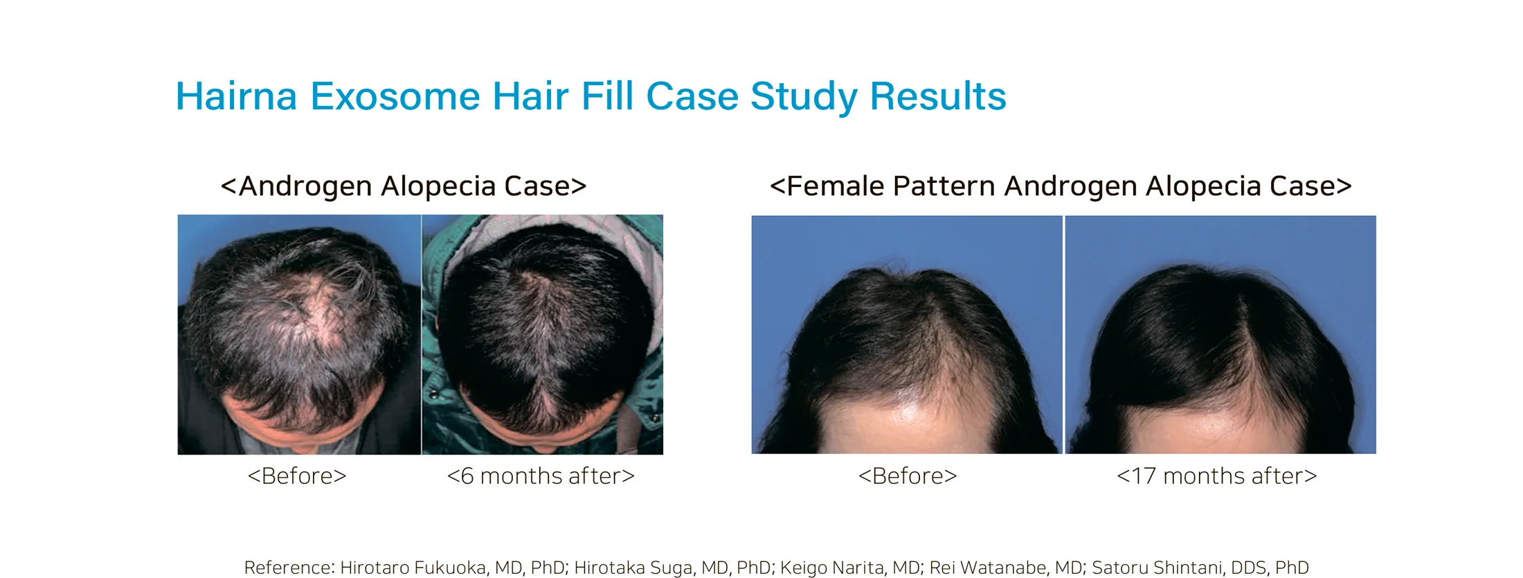 Hairna Hair Fill 1 13 22784C1B - Botoderm