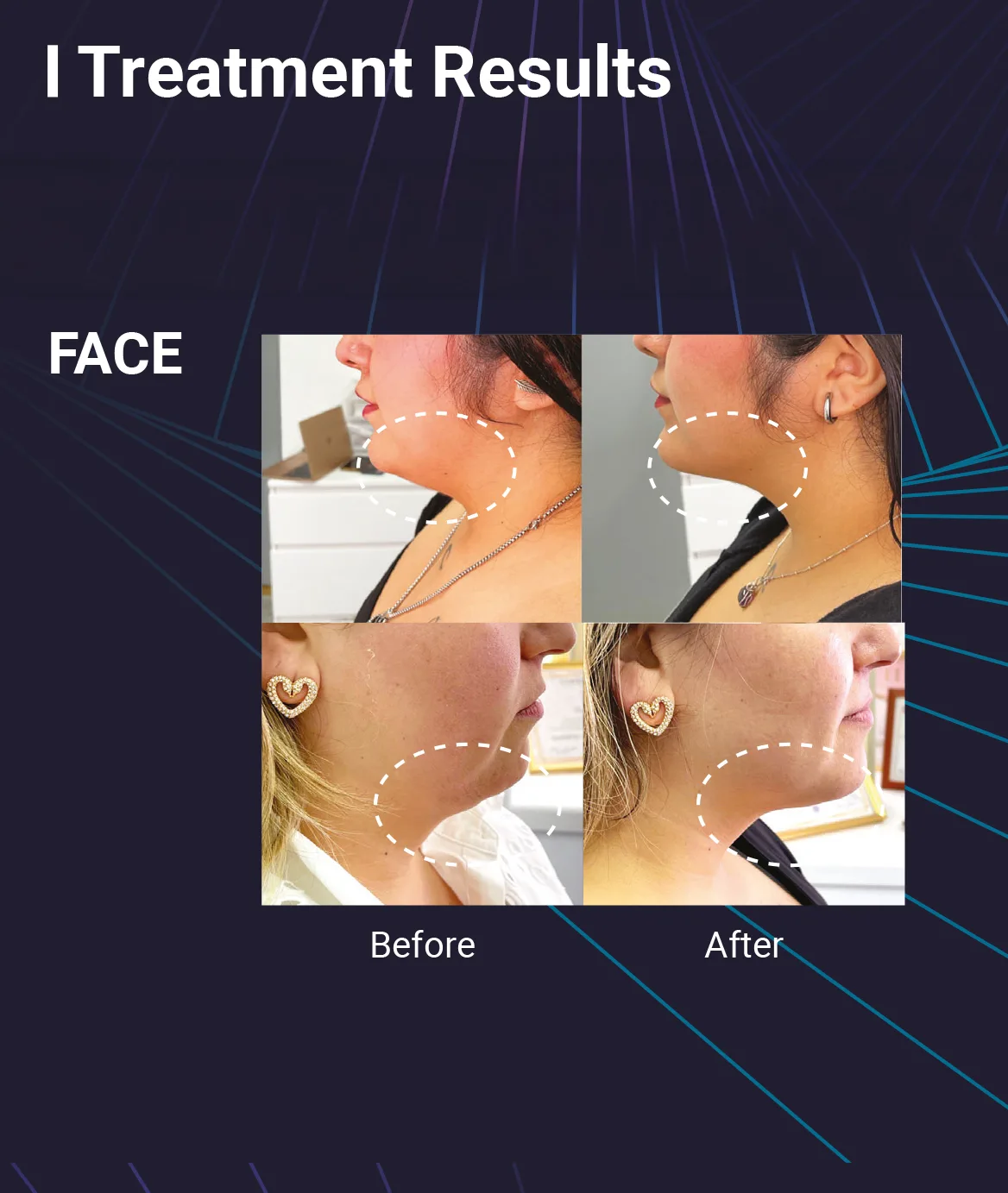 Liporah Face 05 D39C2156 - Botoderm