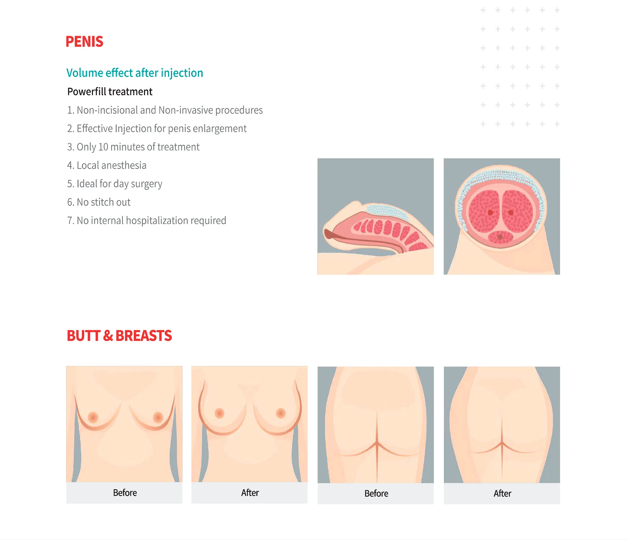 Powerfill Brochure En 1 08 A1106253 - Botoderm