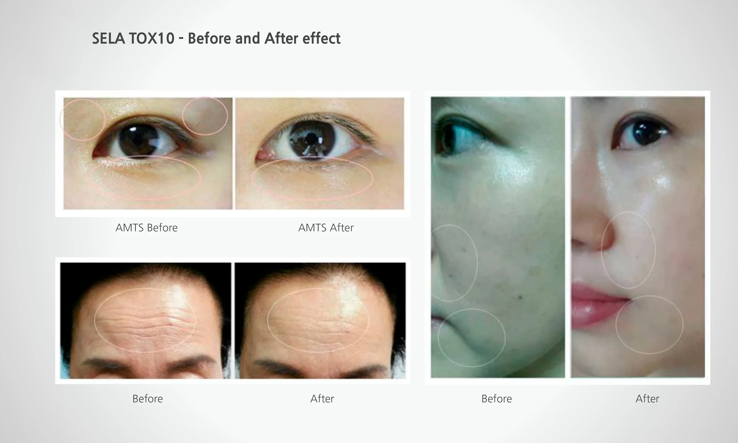 Selatox1 04 9Bf0Fa3C - Botoderm
