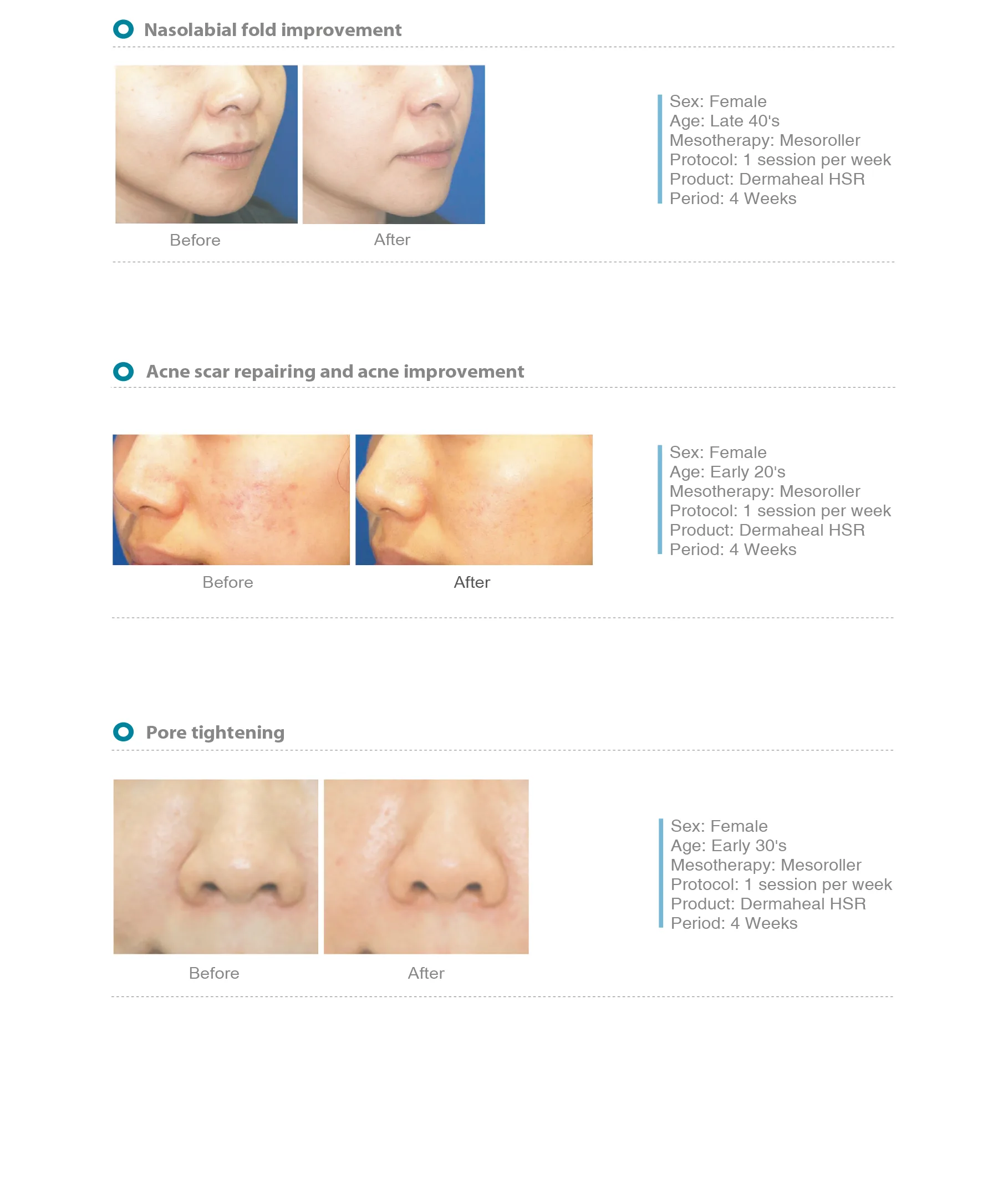 Dermaheal Hsr 05 B83C22A6 - Botoderm