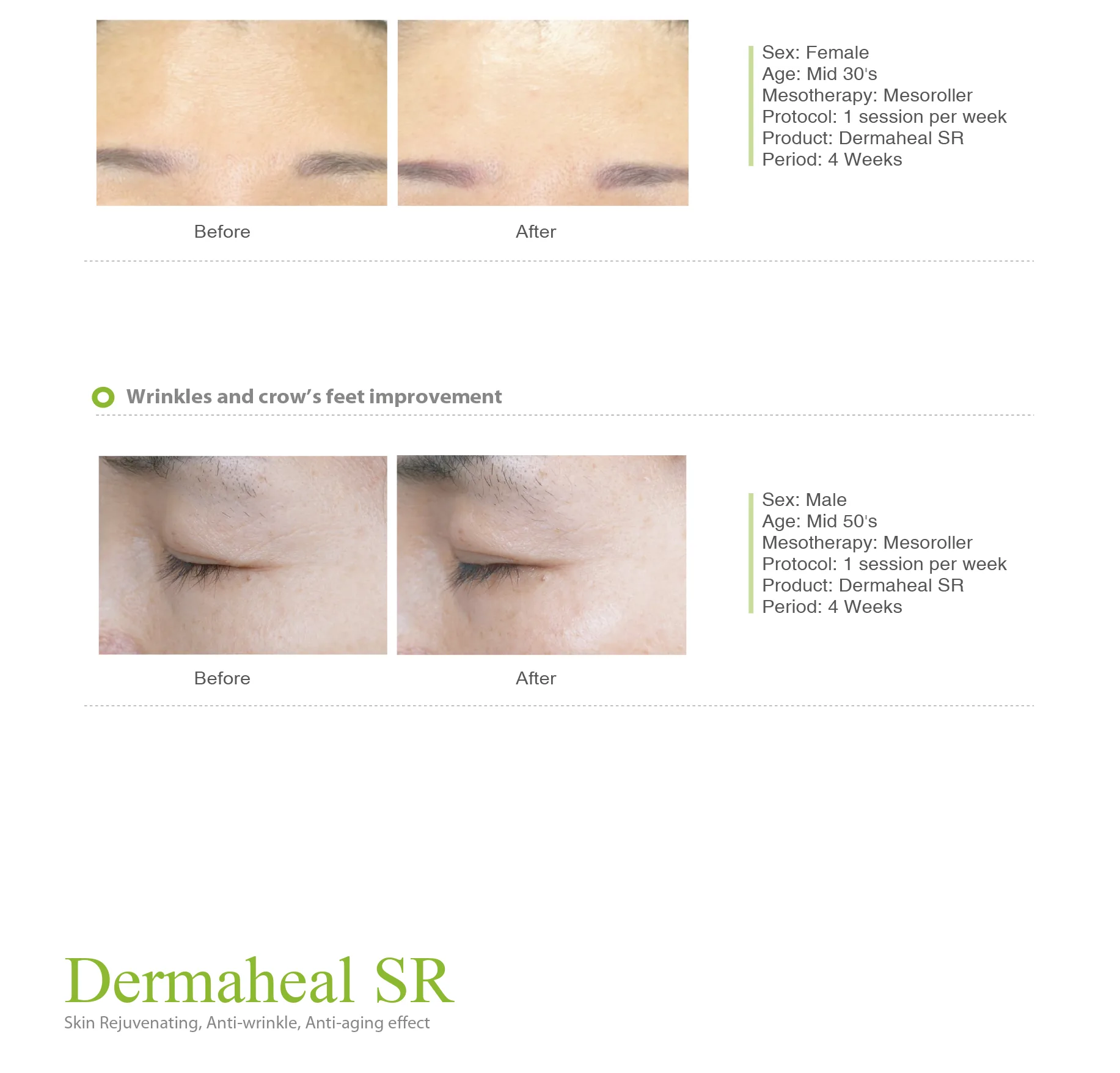 Dermaheal Sr 05 C563C96D - Botoderm