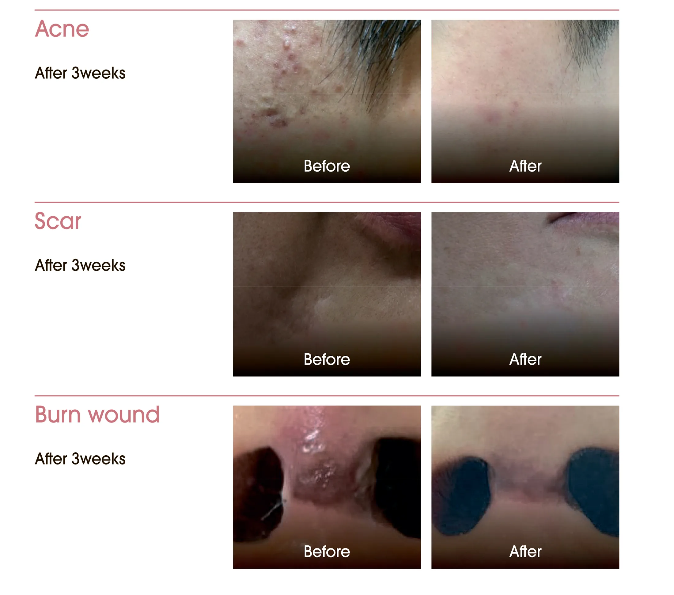 Exoxe Face 11 8Bb2B1Ee - Botoderm