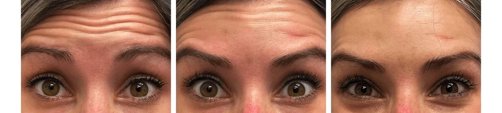 Why Does Botulinum Toxin Work Differently For Everyone? 2 Toxinbeforeafter1 4Da6C333 - Botoderm